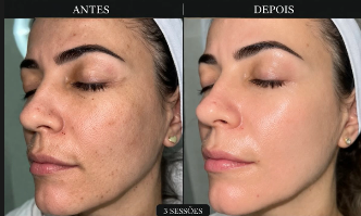 Antes e depois de tratamento de manchas no rosto, após 3 sessões