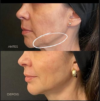 Antes e depois de rejuvenescimento facial