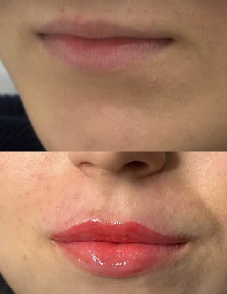 Antes e depois de preenchimento labial