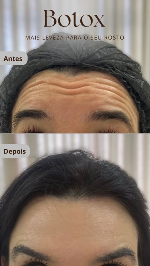 Antes e depois de botox na testa