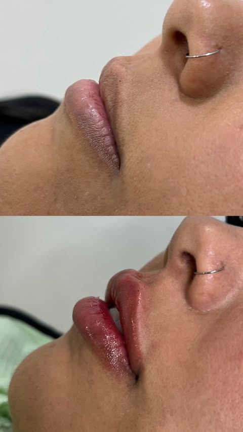 Antes e depois de preenchimento labial, vista lateral